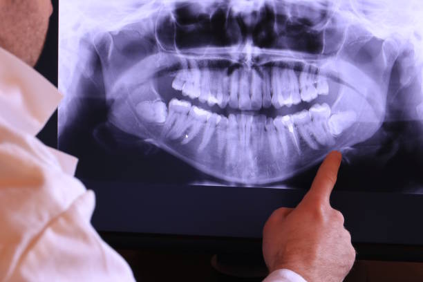 Best Emergency Root Canal Treatment in St John, IN